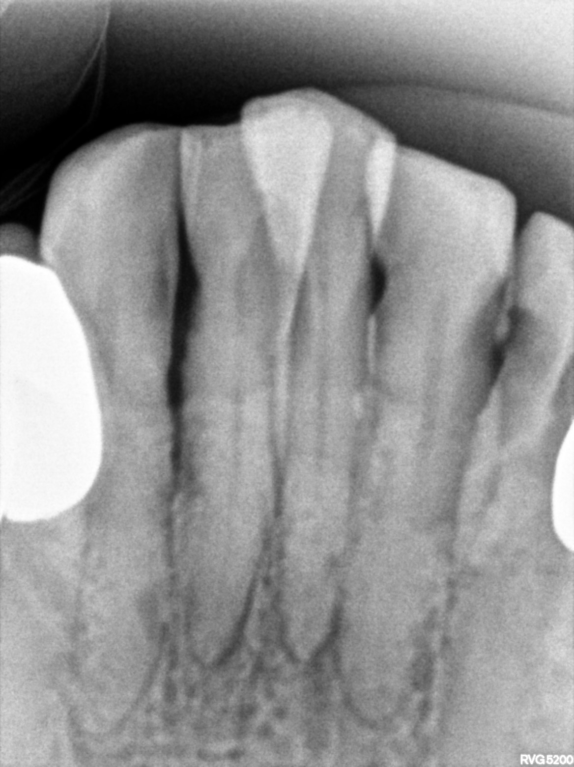 Dental X-ray